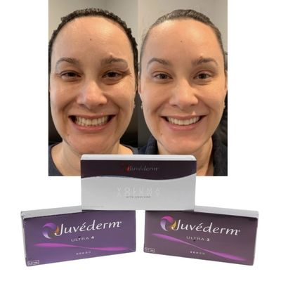 حشوات الشفاه الجلدية Juvederm حمض الهيالورونيك