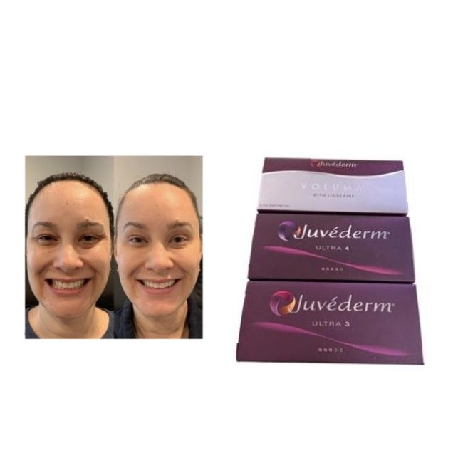 حشو جلدي متقاطع من حمض الهيالورونيك Juvederm Ultra3 Ultra4 Voluma ظروف التخزين تجنب التجميد جل قابل للحقن لاستعادة حجم الوجه